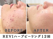 レヴィア(Revia)の雰囲気（ハーブピーリング/ニキビケア/シミケア/六本木/毛穴/肌荒れ）