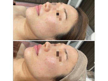 リリ(LiLi)/アンストレス・ビフォーアフター