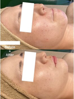 レーヴリゼ(Revelise)/ハーブピーリング