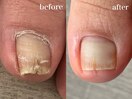 巻き爪ビフォーアフター!