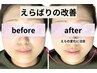 【60分:小顔矯正】“えらばり”徹底改善