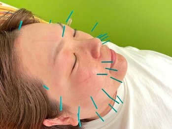 北てんま整骨鍼灸院の写真/【本格美顔鍼で表情筋リフトケア】フェイスライン引き上げ/ほうれい線改善/エラ張り/目元ぱっちり初回¥3980