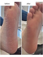 ケアプラス(care plus)/足裏角質ケア