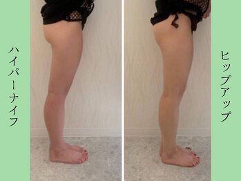 ソルニス(Solnis.)/痩身☆脂肪分解/ハイパーナイフ