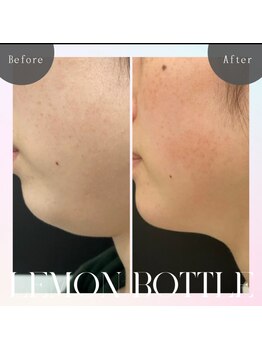 シズク ビューティーサロン(SHIZUKU beauty salon )/レモンボトル