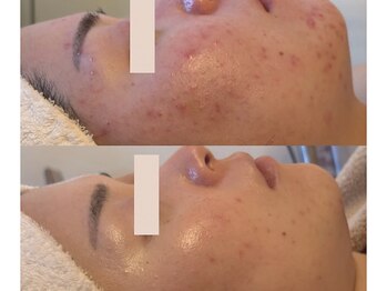 アン(An)/繰り返す肌トラブル