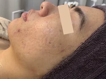 ウェクシー 名古屋駅前店(WECXII)/赤みもニキビもない肌に