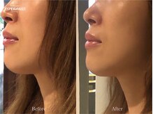 エステティックサロン エスぺランス(ESPERANCE)/リガメントフェイシャル