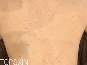 トップスキン 名駅(TOPSKIN)/背中のトラブル徹底改善!