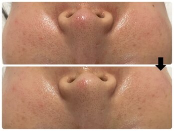 エフェクト 塚口店(effect)/Before After 30代/2回目