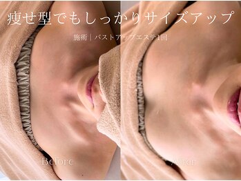 エメ(Aimee)/バストアップエステ