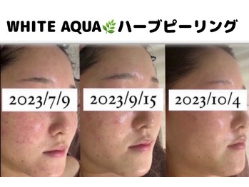 ホワイトアクア 柏店(WHITE AQUA)/ハーブピーリング/肌荒れ/毛穴