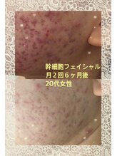 フォルチェ ゆめタウン東広島店(Folche)/幹細胞フェイシャル