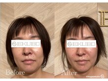 エクボ 立川店(EKUBO)/巡らせてお顔回りすっきり効果◎