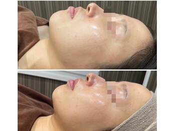 リリ(LiLi)/アンストレス・ビフォーアフター