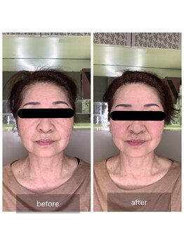 アース 稲毛海岸店(HAIR & MAKE EARTH)/小顔リフト整顔