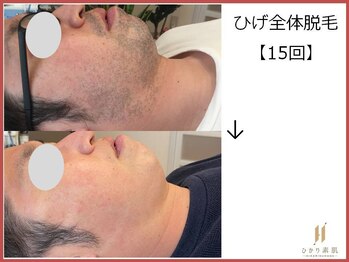 ひかり素肌/ひげ脱毛15回