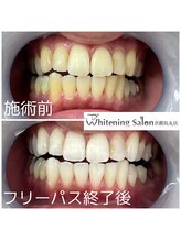 ホワイトニングサロン 京都烏丸店/ホワイトニング施術例