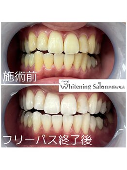 ホワイトニングサロン 京都烏丸店/ホワイトニング施術例