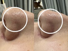 ケアナ 梅田店(CareNa)/サヨナラいちご鼻★黒ずみ洗浄