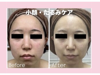 エステティック　レイビス 渋谷店(RAYVIS)/小顔たるみ引き締めケア