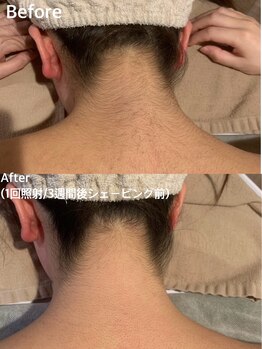 アンダンテ(Andante)/脱毛Before After