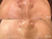 ウォーム(warm)/シミケア/美白/脱ピーリング