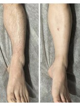 ヴィプラス(VIPLUZ)/膝下脱毛