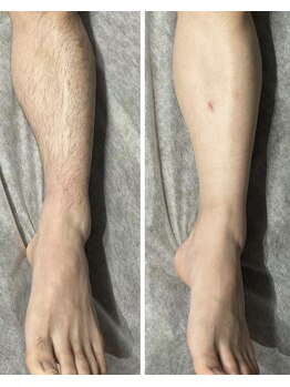 ヴィプラス(VIPLUZ)/膝下脱毛