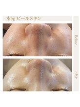 水光ピールスキン/水光ピール＋毛穴洗浄プラズマ