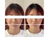 【2回目以降】小顔/リフトアップ特化美容鍼 60分 ¥11000