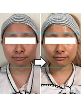 きしの美容整体院/フェイシャルリフトケアBA