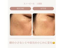 話題のスノーピール！肌変化を見て触ってご体感ください♪