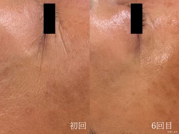 ウォーム(warm)/シワケア/小顔/マッサージ/小顔