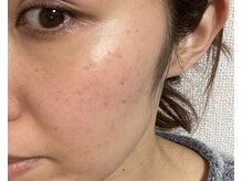 ベルーチェ(Beluce)/本格的なニキビケア