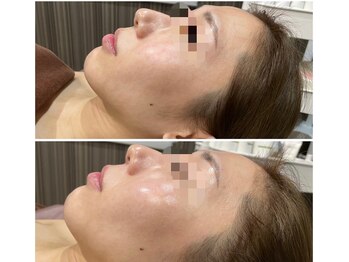 リリ(LiLi)/ビオフィート・ビフォーアフター