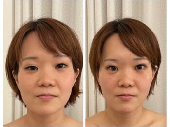 ソラ(sora)/【小顔コルギ症例】