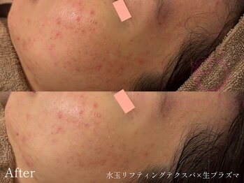 サロンヴェアリー 広尾(salon vary)/ニキビケア#赤み#白ニキビ