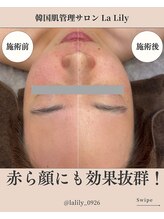 ラ リリー ステラ(La Lily stella)/赤ら顔も改善！乾燥の時期にぜひ