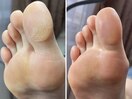 足裏角質ケア