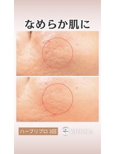 ジヒカ(ZIHICA)/【進化版★ハーブピーリング】