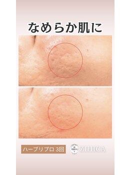 ジヒカ(ZIHICA)/【進化版★ハーブピーリング】