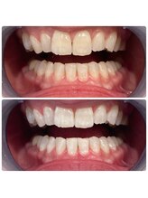 エクシアホワイトニング 日本橋店/茅場町ホワイトニング