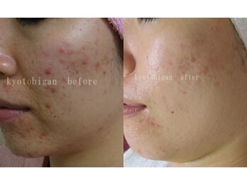 京都美顔/頬に広がるストレスニキビケア