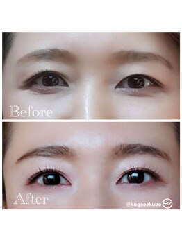 エクボ 立川店(EKUBO)/パッチリ二重に!左右差改善!!!