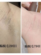 ヴィプラス(VIPLUZ)/脇脱毛で臭い対策