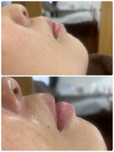 ラピス(Lapis)/シェービングエステ