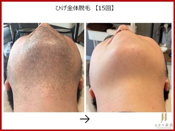 ひかり素肌/ひげ脱毛15回