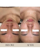 インフィニーズ(INFINEEZ)/カスタマイズ90分毛穴改善20代