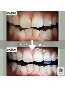 ハチ(HACHI)/美容ホワイトニング